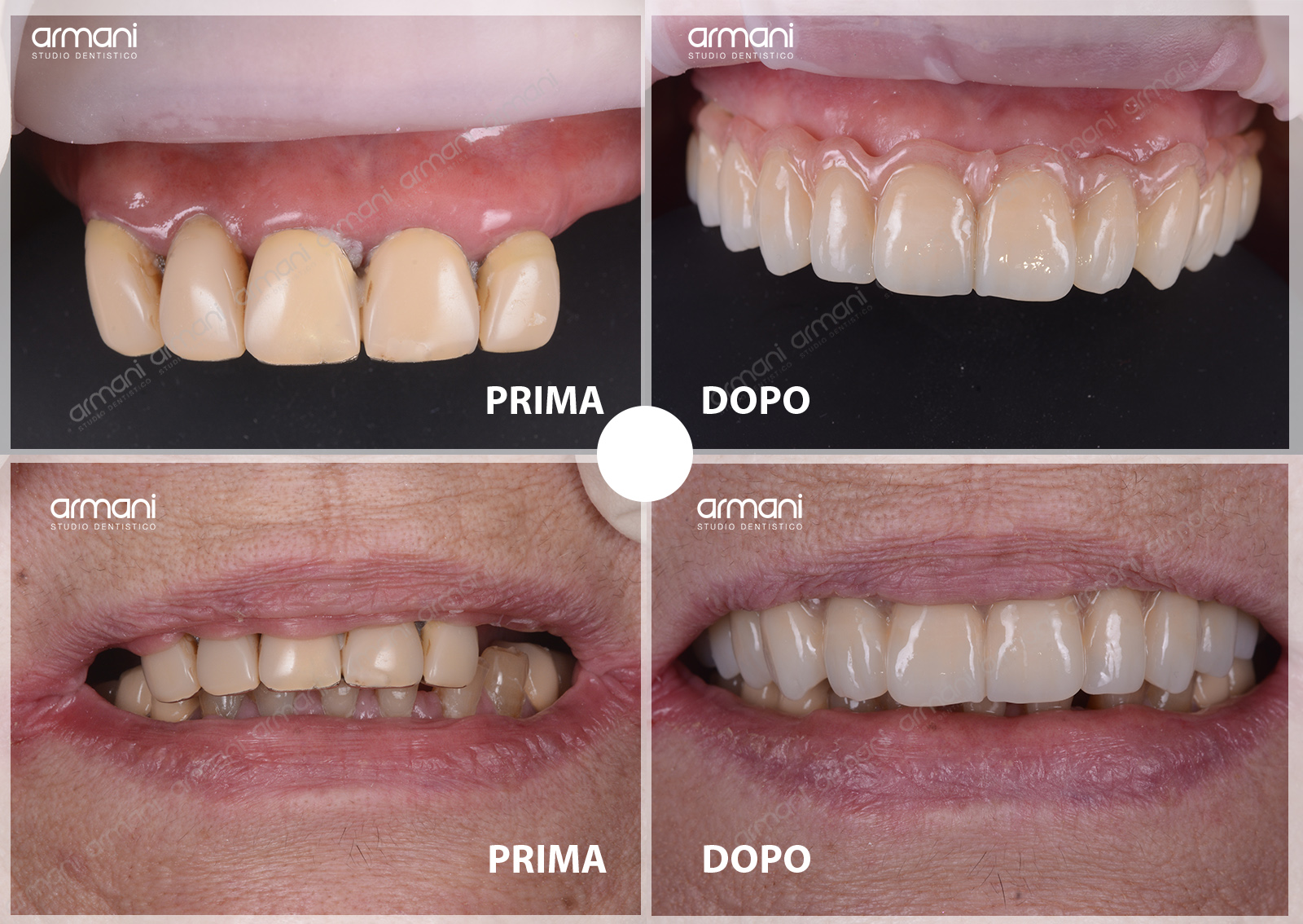 Protesi Dentali Mobili a Verona Studio Dentistico Armani