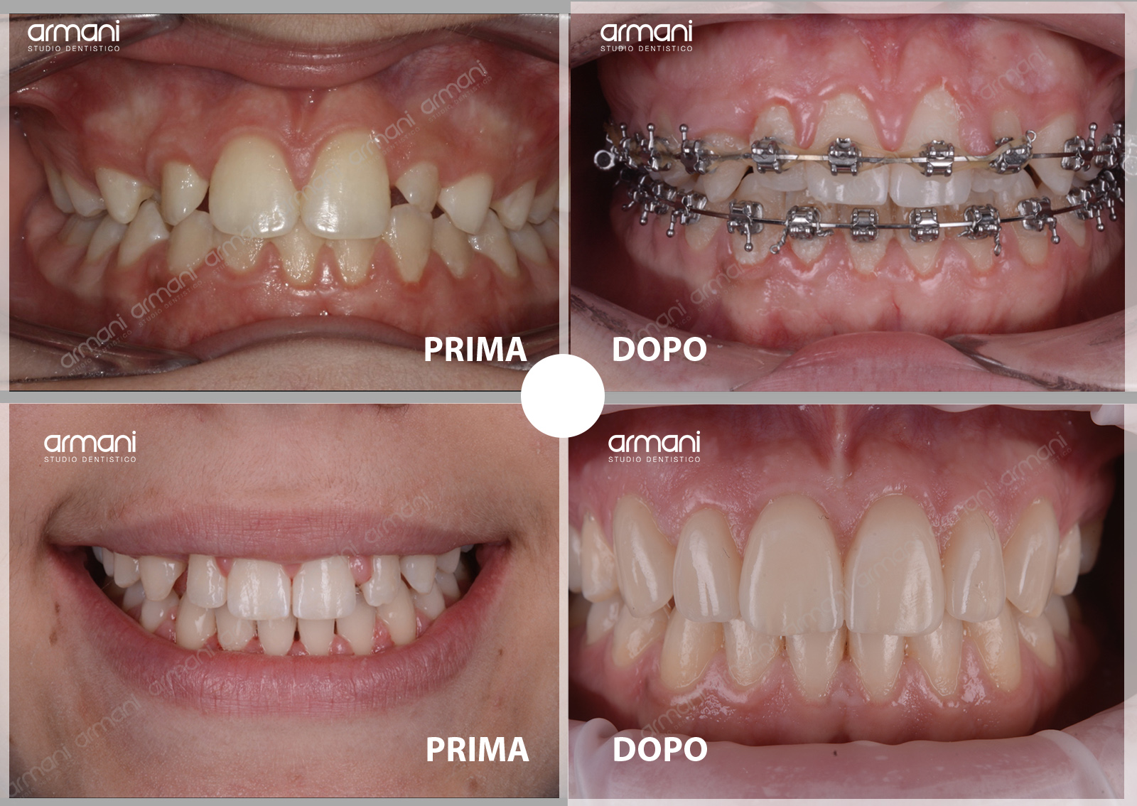 Faccette Estetiche dentali a Verona - Studio Dentistico Armani